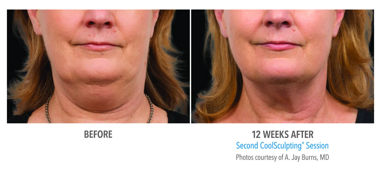 coolsculpting whitby ontario +1 289-272-242430