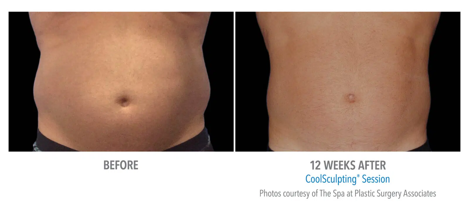 Coolsculpting Whitby - Skin Vitality Medical Clinic Whitby 1614 Dundas St E Unit 101, Whitby, ON L1N 8Y8  1 289-272-2424