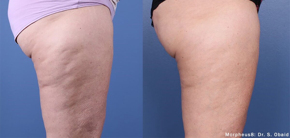 Morpheus8 before and after at Skin Vitality Ontario