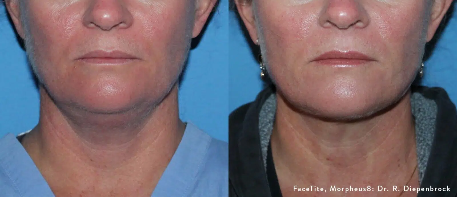 Morpheus8 before and after at Skin Vitality Ontario