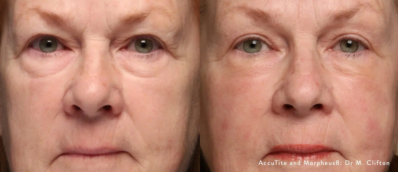Morpheus8 before and after at Skin Vitality Ontario