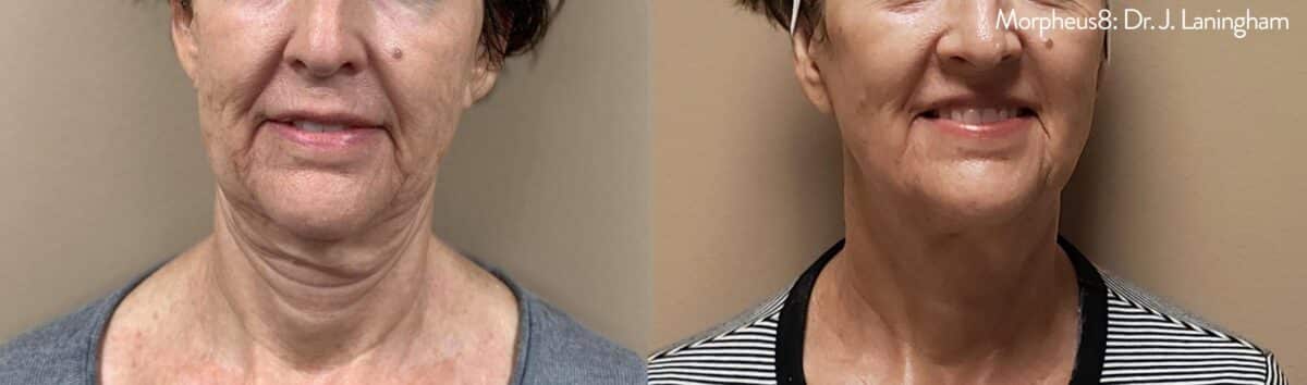 Before and After Morpheus8