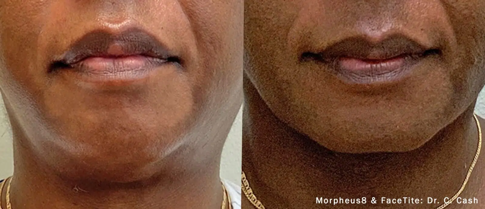 morpheus8 whitby ontario +1 289-272-2424