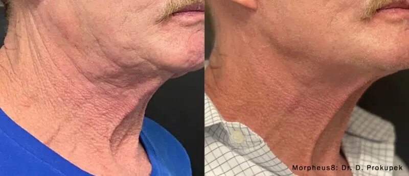 Morpheus8 before and after at Skin Vitality Ontario