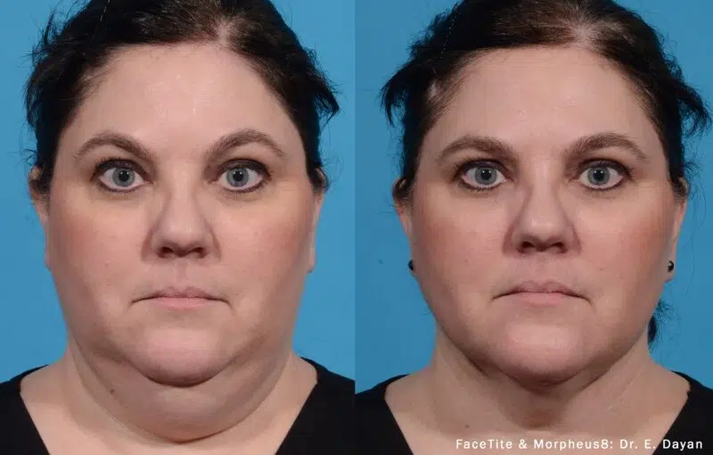 Morpheus8 before and after at Skin Vitality Ontario