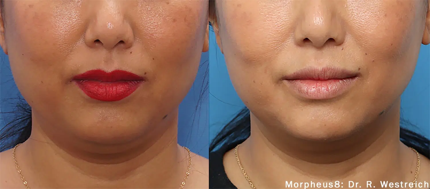 morpheus8 whitby ontario +1 289-272-2424