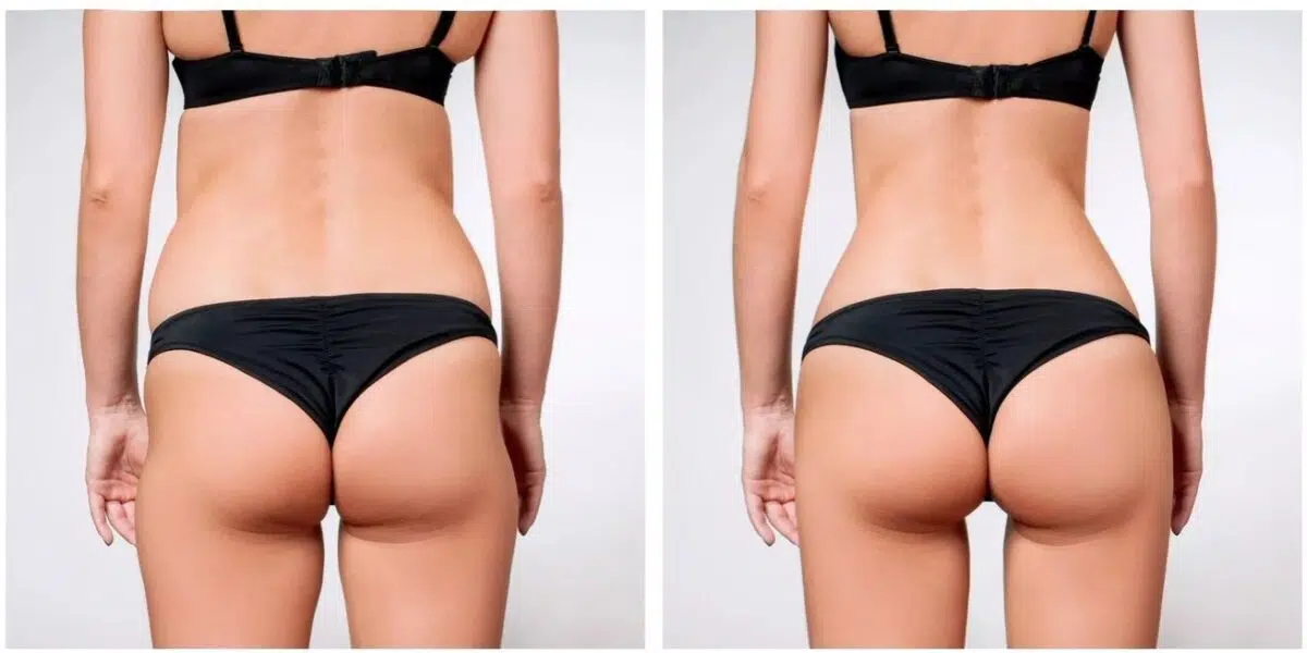 sculptra hip dip before and after