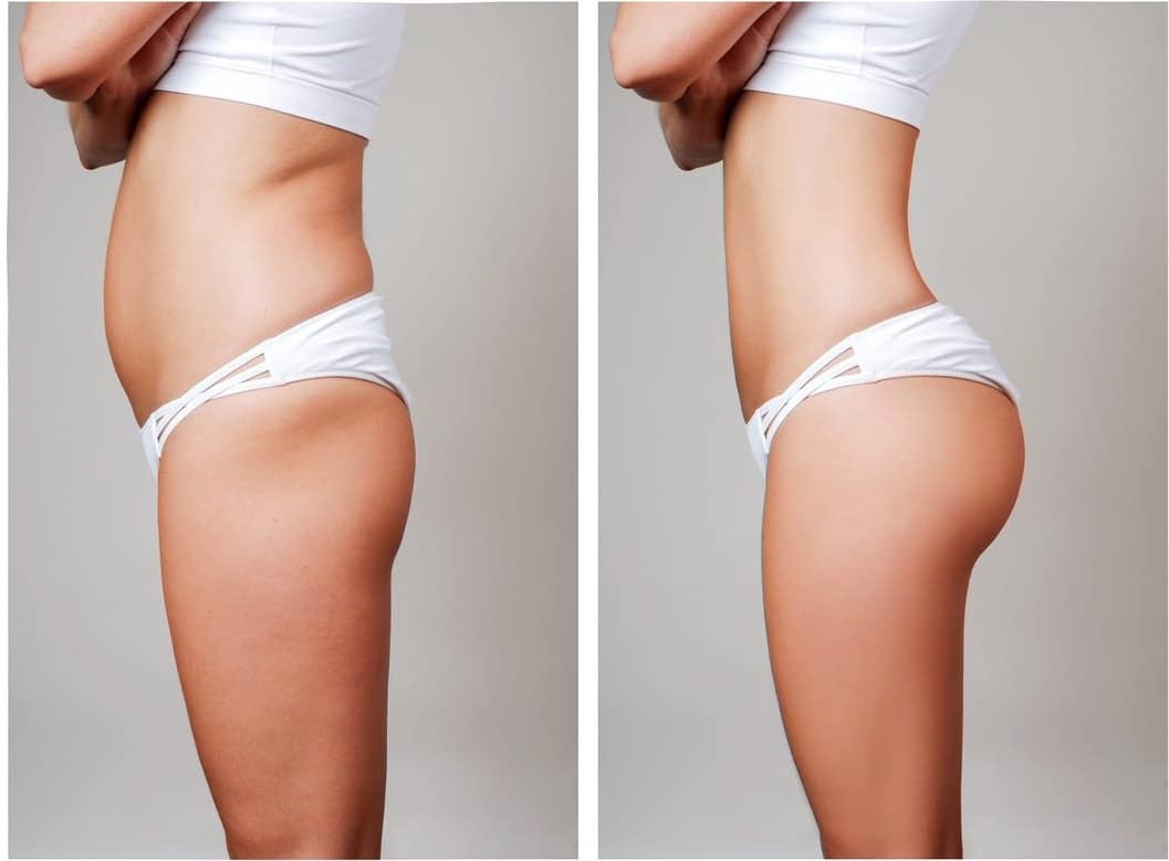 sculptra hip dip before and after