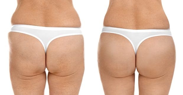 sculptra hip dip before and after