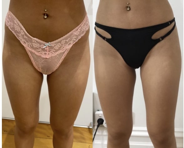 sculptra hip dip before and after