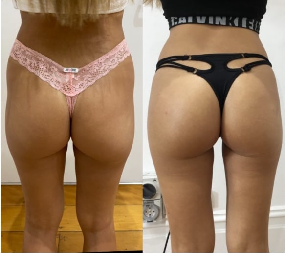 sculptra hip dip before and after