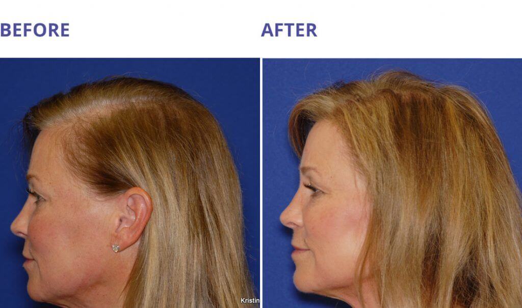 PRP Hair Treatment Toronto | PRP Hair Restoration Ontario PRP Hair Treatment Toronto | PRP Hair Restoration Ontario