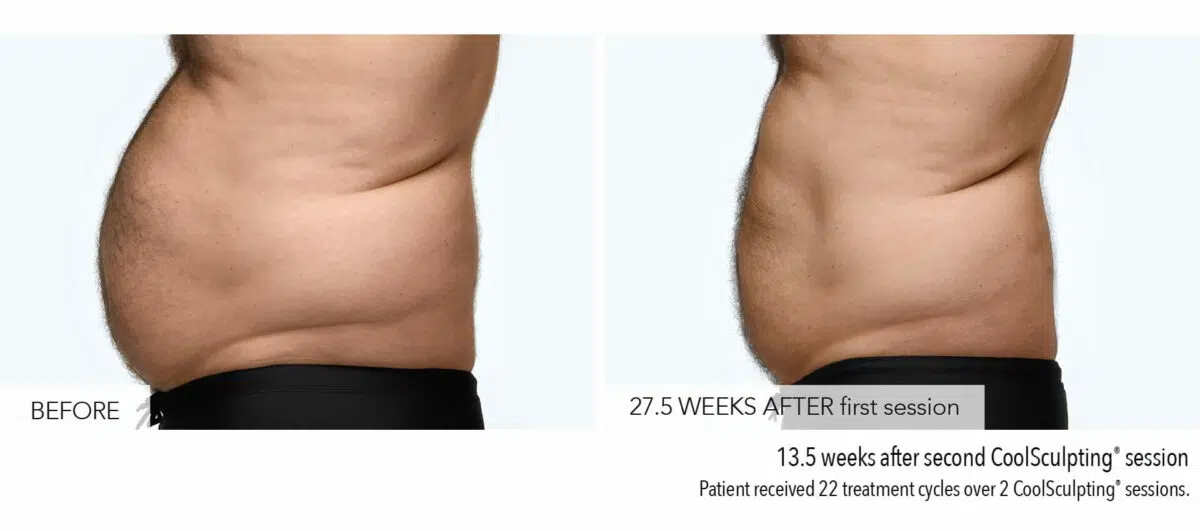 CoolSculpting Stomach Before and After