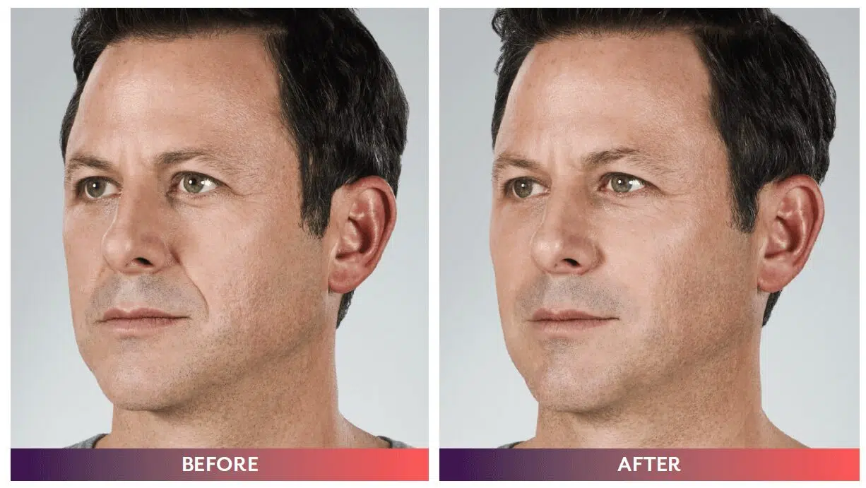 Juvederm for Men