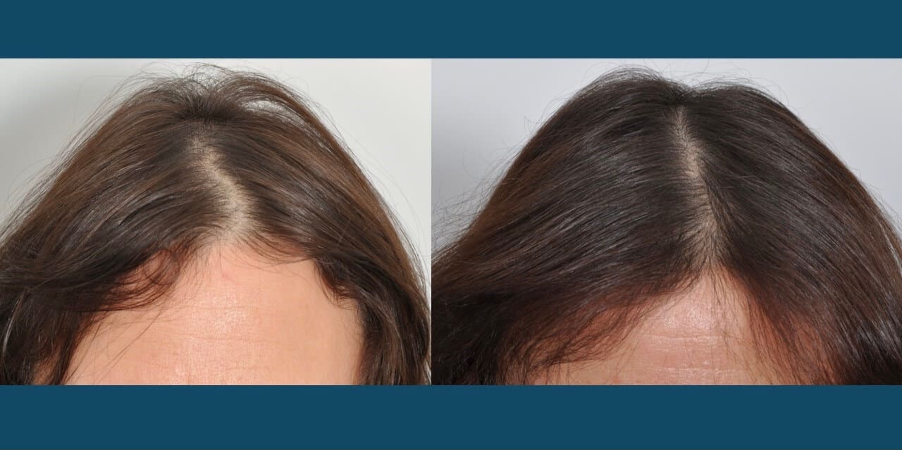 PRP Hair Treatment Toronto | PRP Hair Restoration Ontario PRP Hair Treatment Toronto | PRP Hair Restoration Ontario