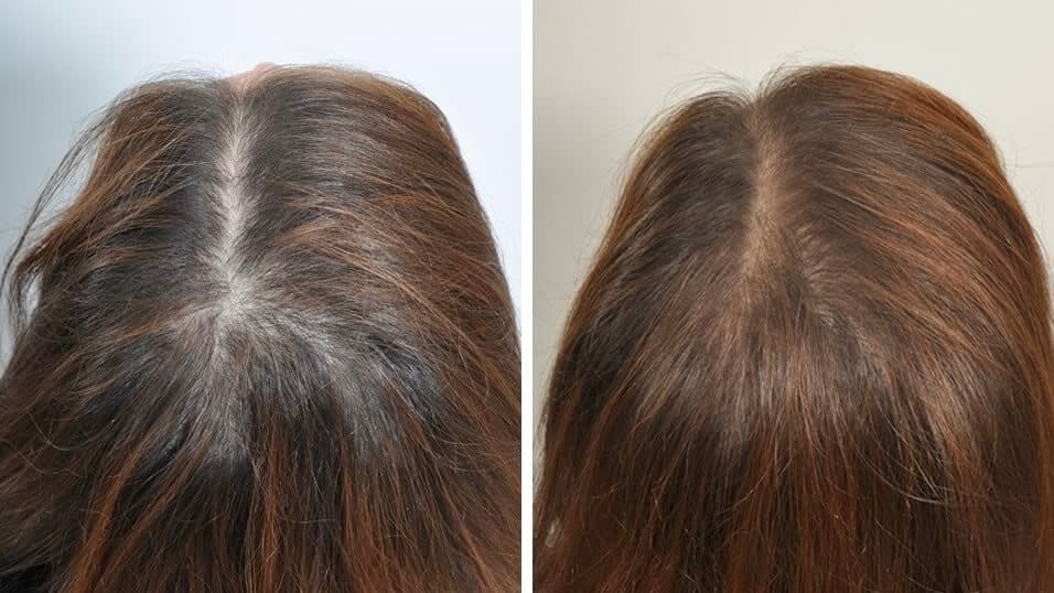 PRP Hair Treatment Toronto | PRP Hair Restoration Ontario PRP Hair Treatment Toronto | PRP Hair Restoration Ontario