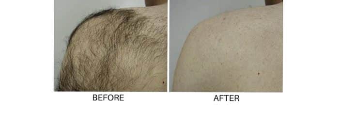 Best Men's Laser Hair Removal Toronto | Laser Hair Removal for Men Near Me Best Men's Laser Hair Removal Toronto | Laser Hair Removal for Men Near Me