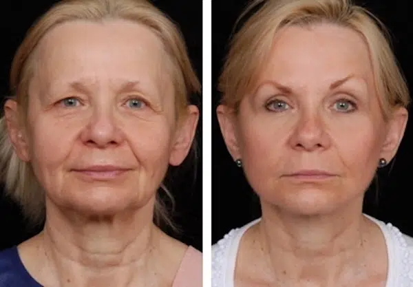 Under Eye Fillers - Before & After Results at Skinly