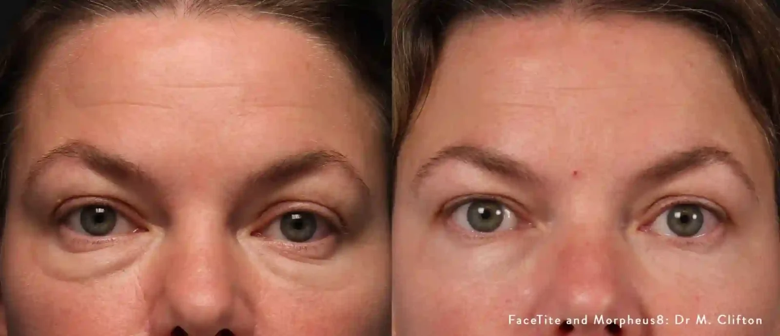 Morpheus8 Before and After