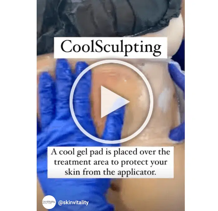 CoolSculpting Oakville