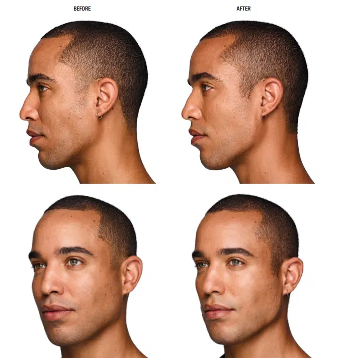 1. Jawline Juve B+A