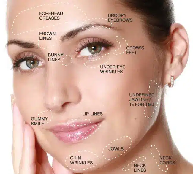 Botox Treatment Areas