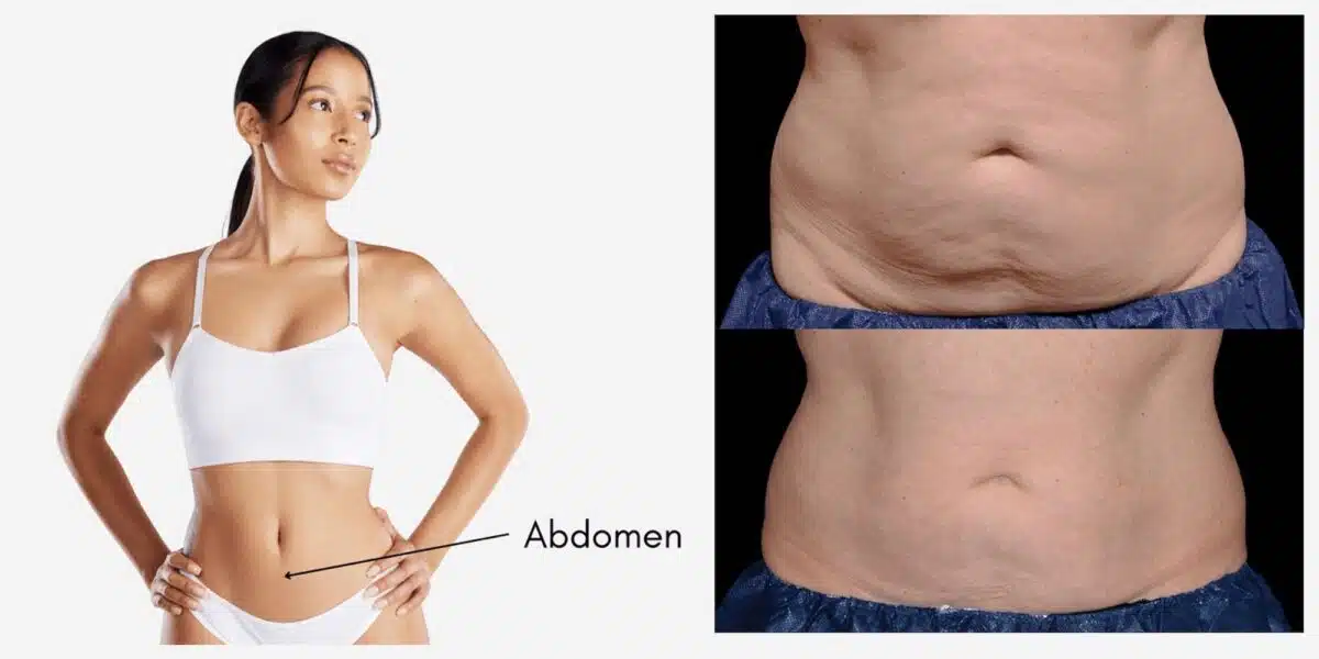 CoolSculpting Abdomen