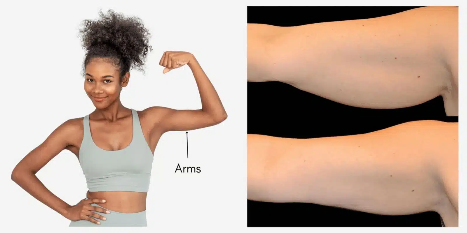 CoolSculpting Arms