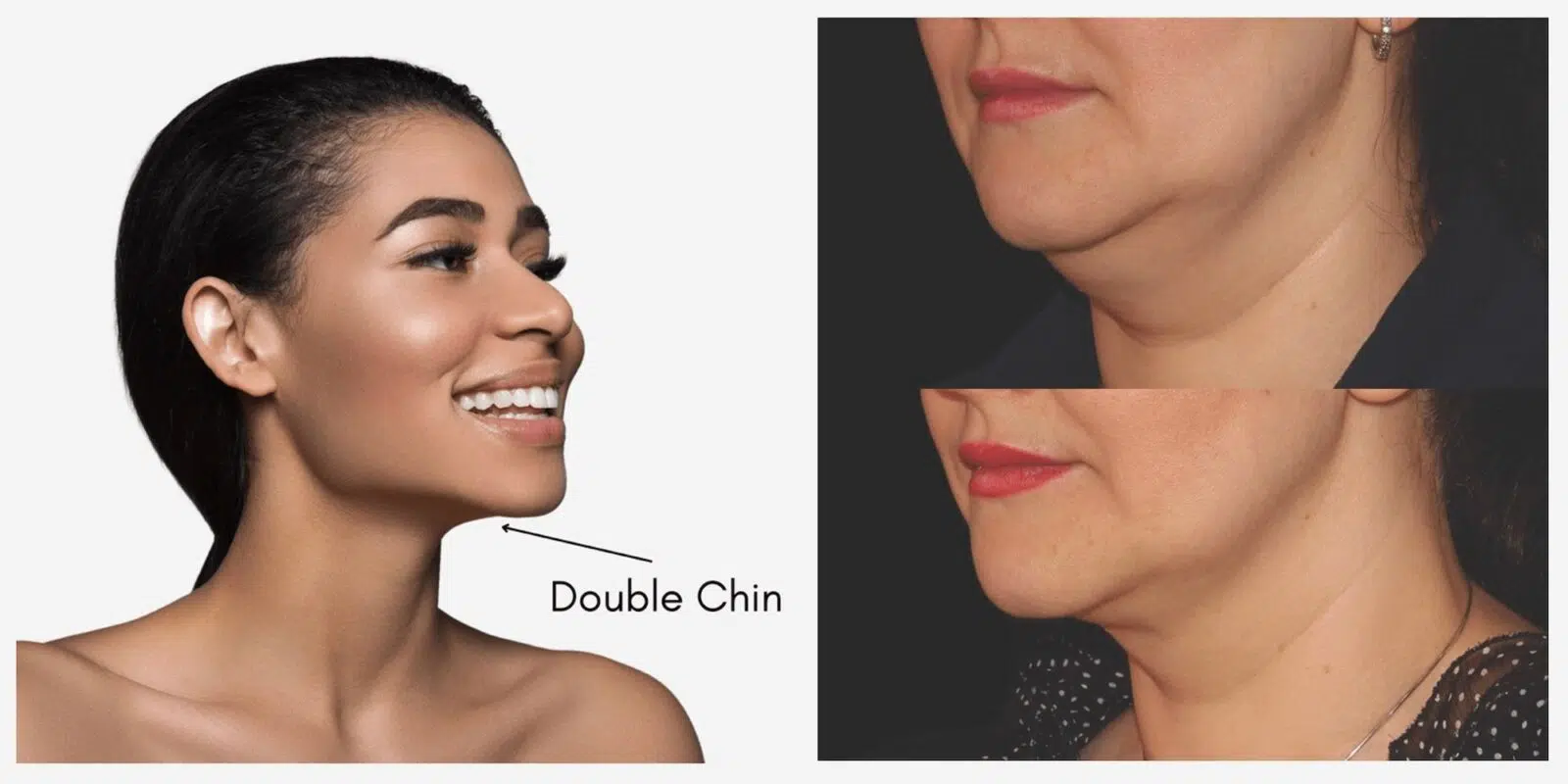 CS Double Chin Fat removal