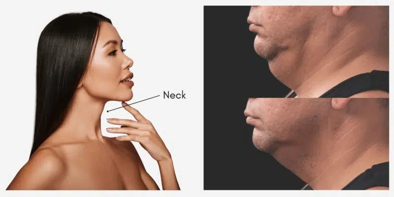 CS Neck