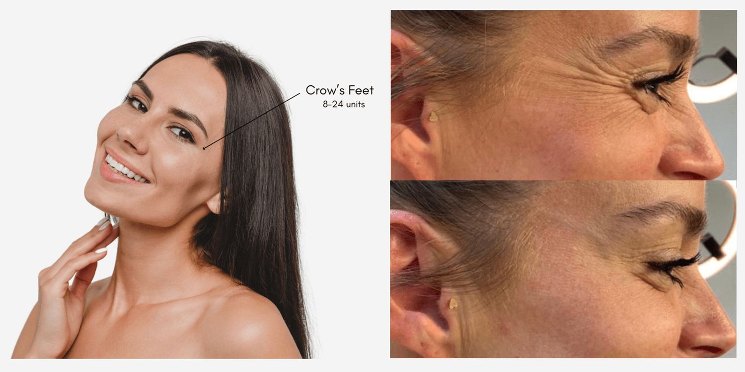 Botox crows feet target area