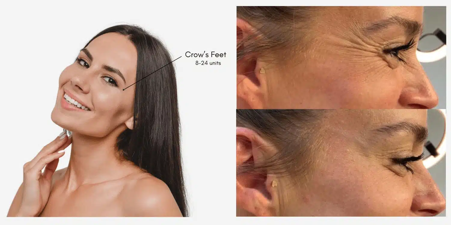 Botox crows feet target area