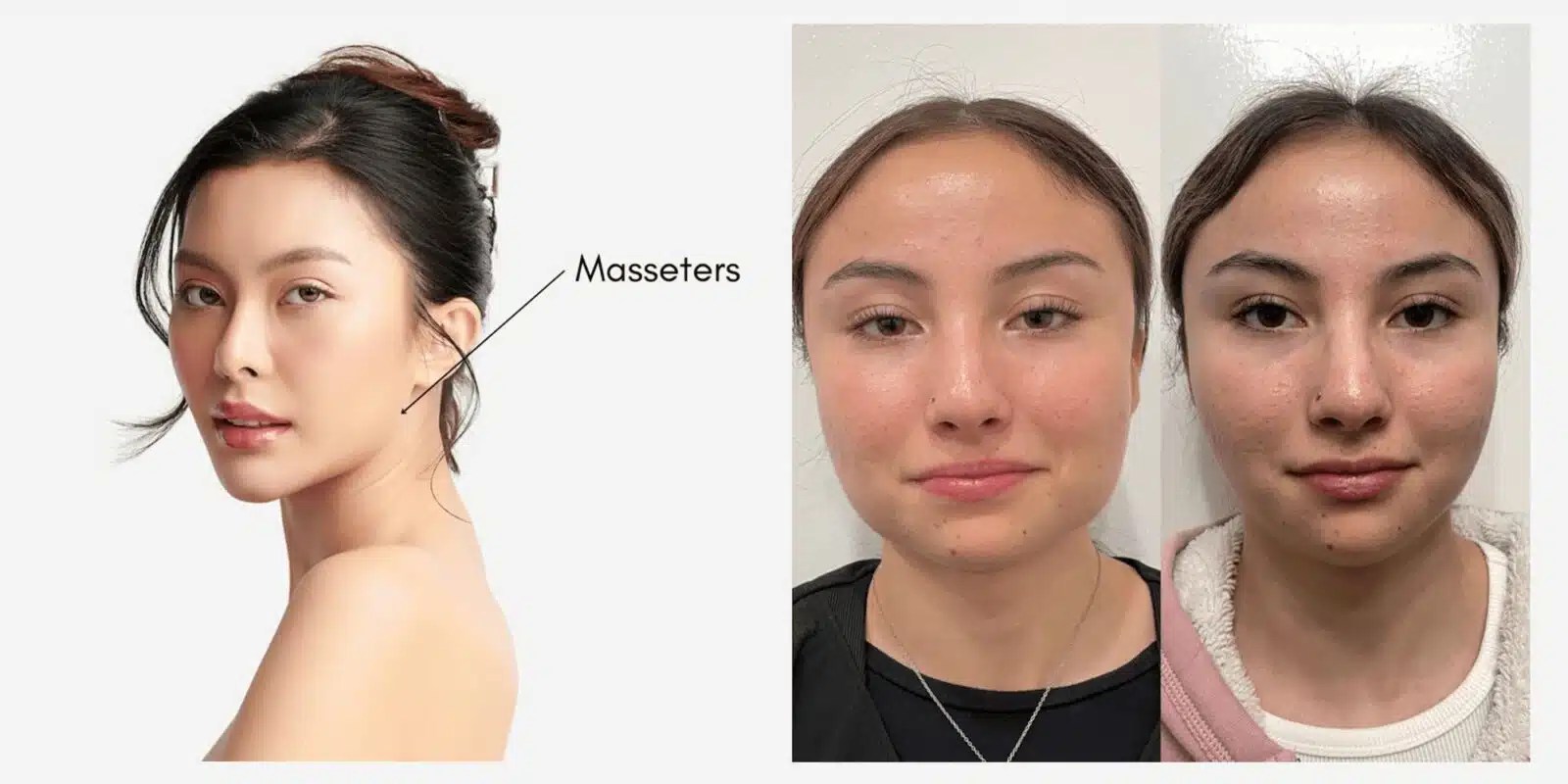 Dysport Masseters