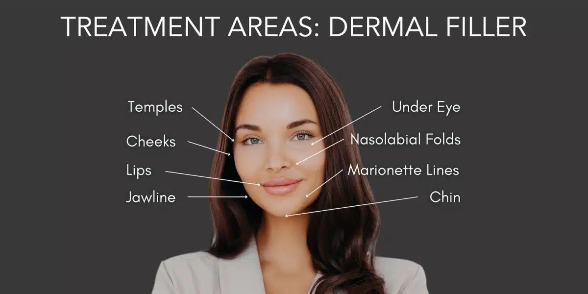 Juvederm Filler Treatment Areas