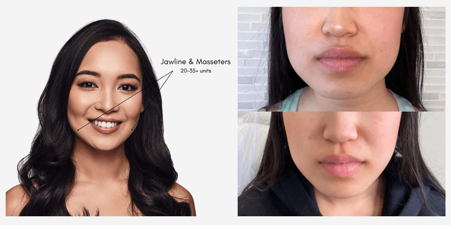 Masseter Botox