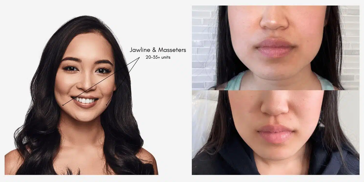 Masseter Botox