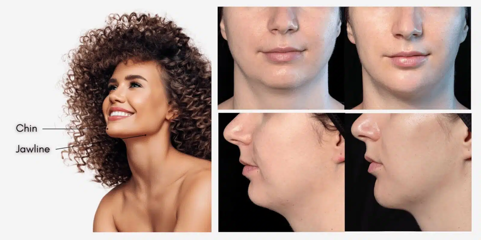 Juvederm Chin / Jawline
