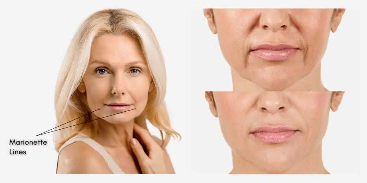 Juvederm Marionette Lines