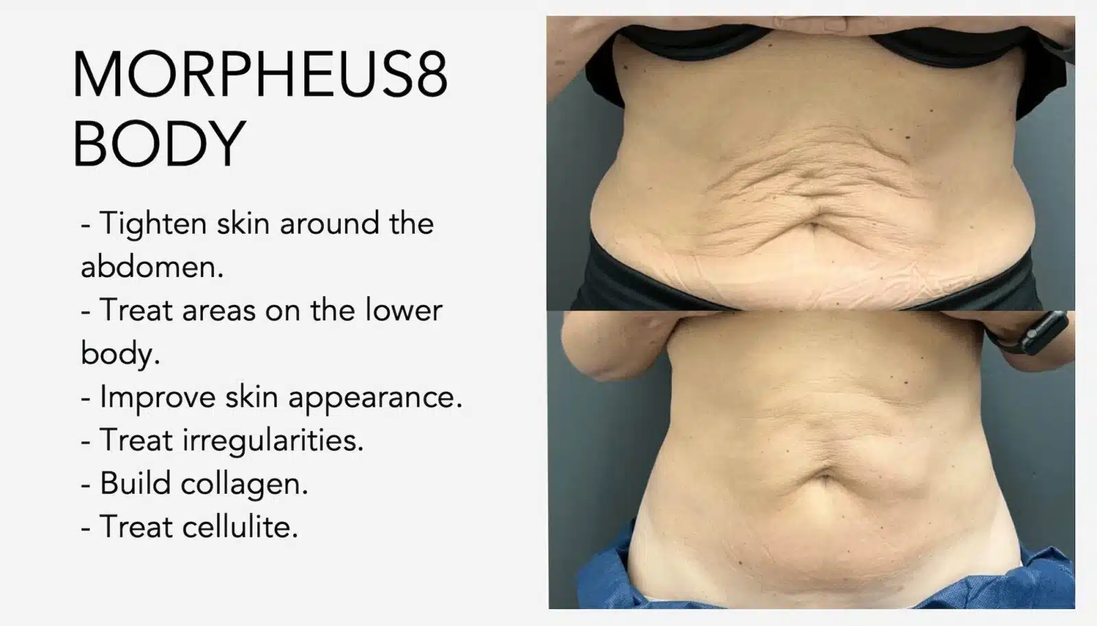 Morpheus8 Body Treatments