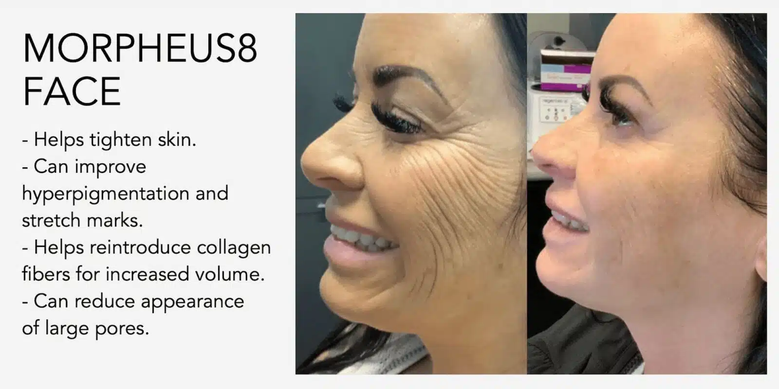 Morpheus8 Face Treatments