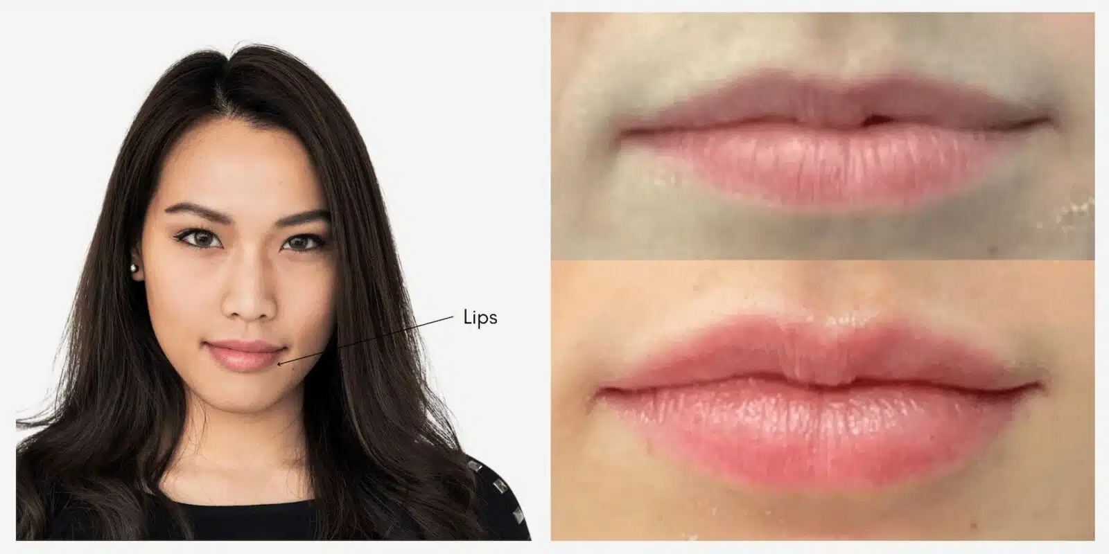Teosyal Lip Filler