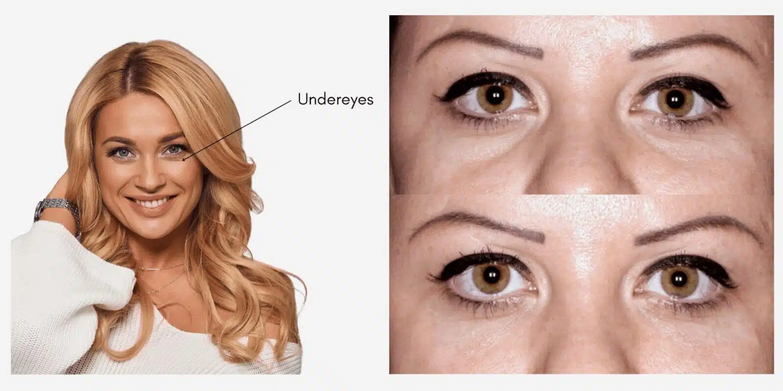 Undereye Filler