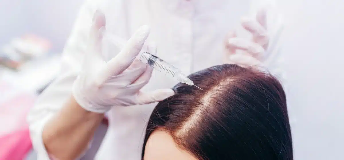PRP Hair Restoration