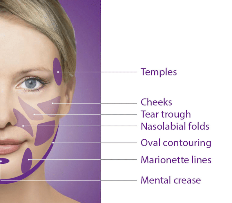 Collagen Injection Areas Sculptra