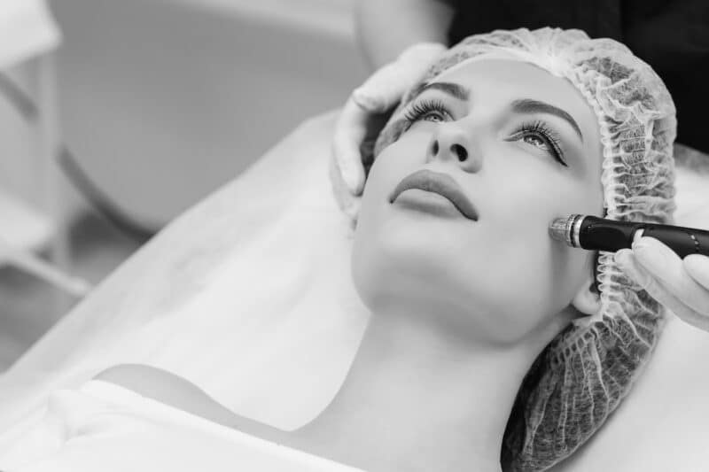 Dp4 Microneedling with Exosomes in Ontario