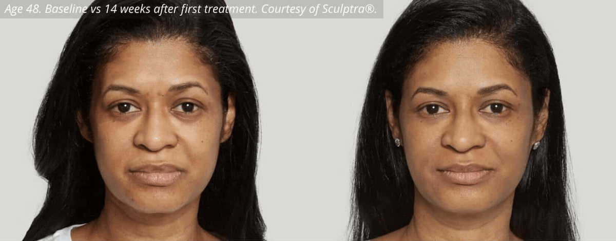 Facial Collagen Injections Before and After
