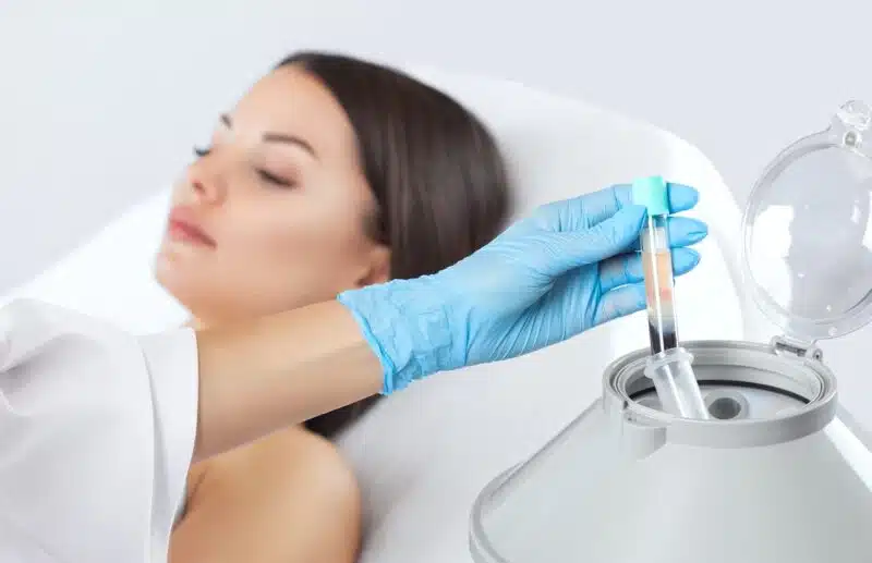 PRP Vampire Facial