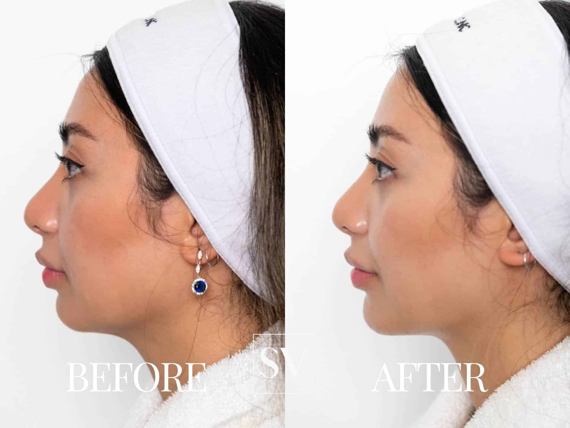 Filler Before and After