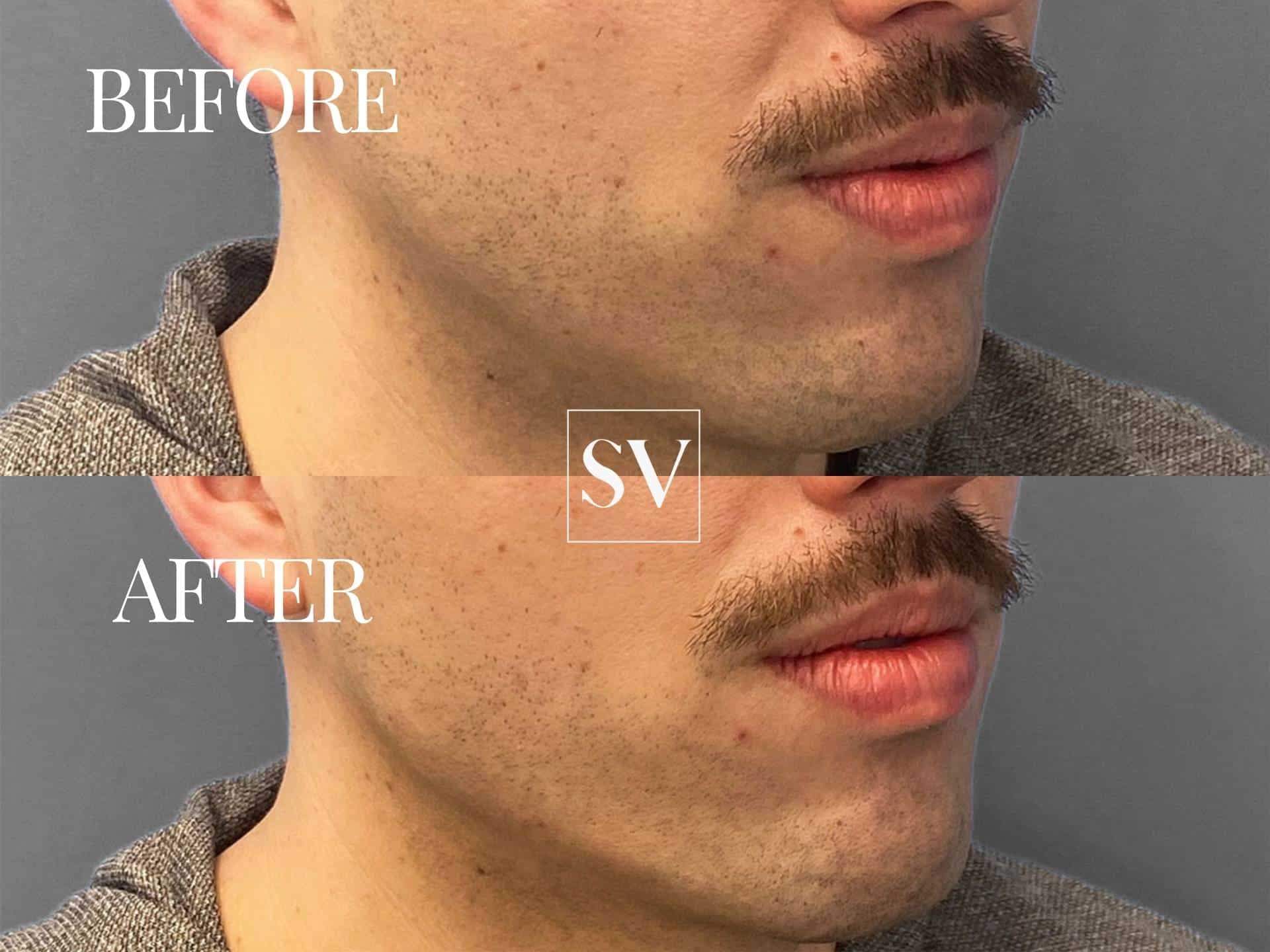 Filler Before and After
