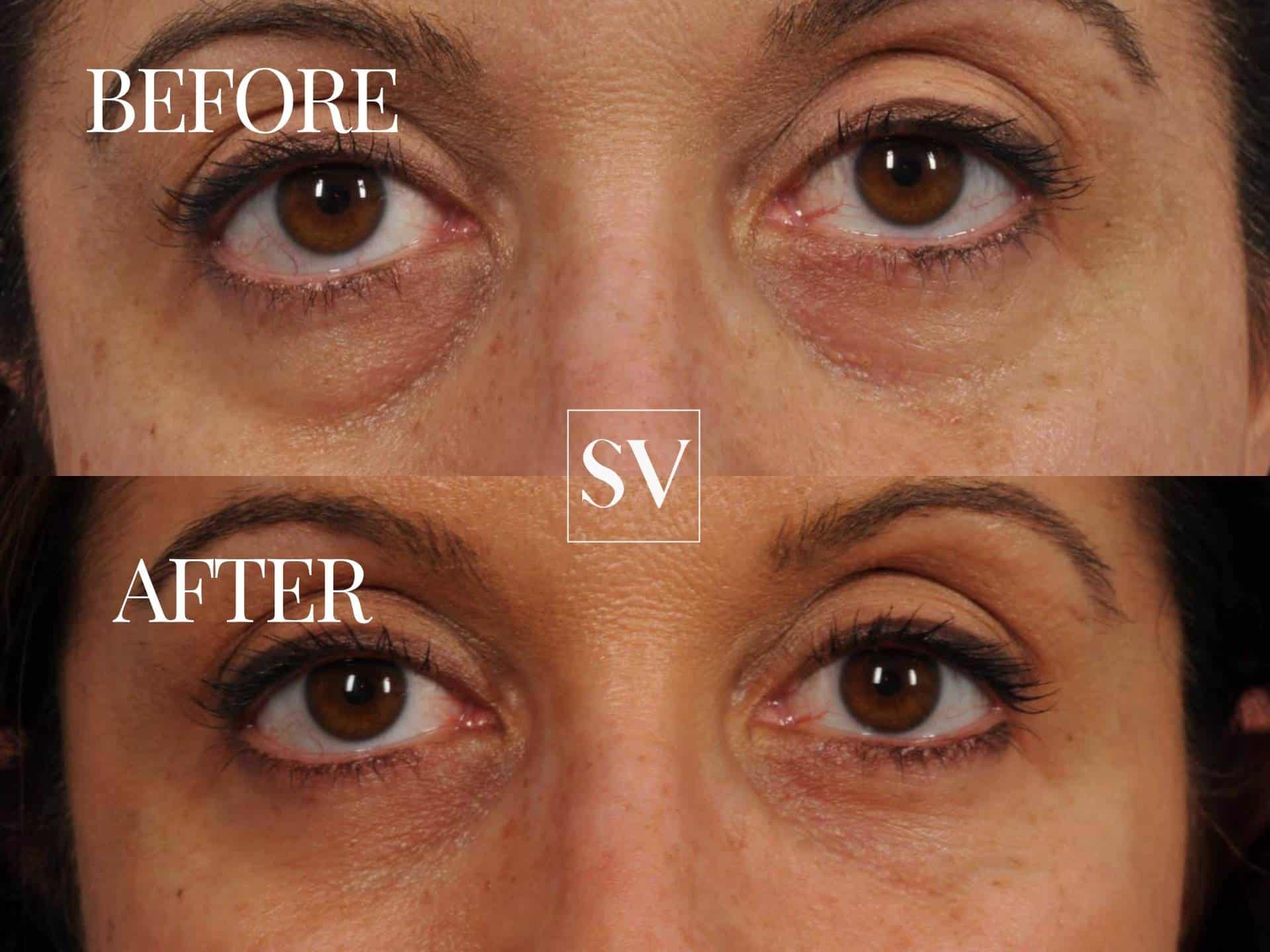 Filler Before and After